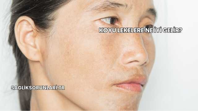 Koyu Lekelere Ne İyi Gelir?