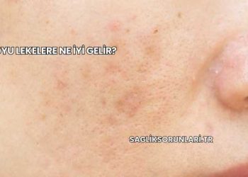 Koyu Lekelere Ne İyi Gelir?