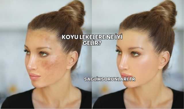 Koyu Lekelere Ne İyi Gelir?