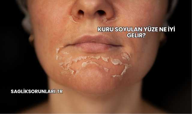 Kuru Soyulan Yüze Ne İyi Gelir?