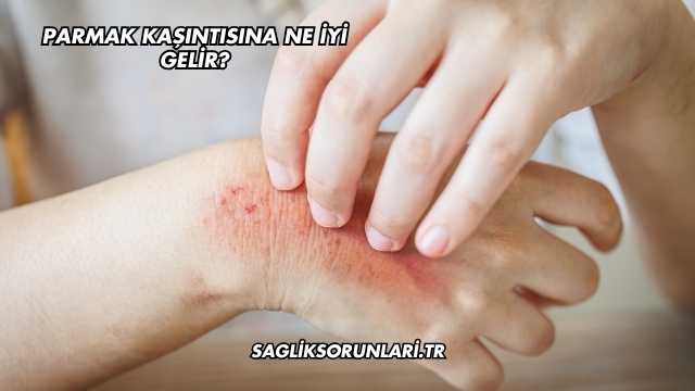 Parmak Kaşıntısına Ne İyi Gelir?