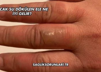 Sıcak Su Dökülen Ele Ne İyi Gelir?