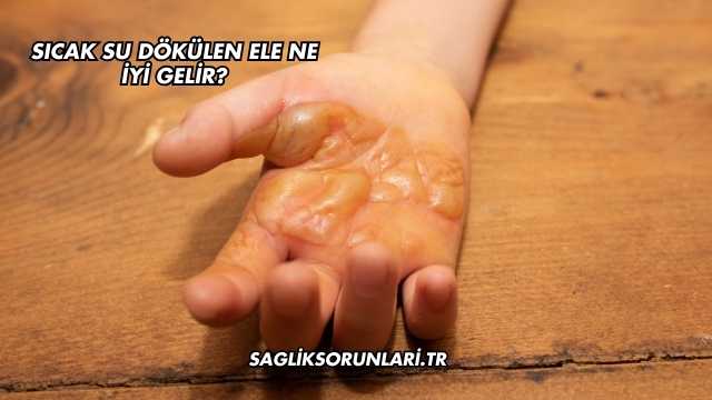 Sıcak Su Dökülen Ele Ne İyi Gelir?