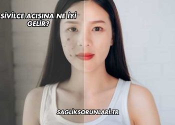 Sivilce Acısına Ne İyi Gelir?