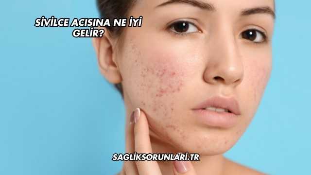 Sivilce Acısına Ne İyi Gelir?