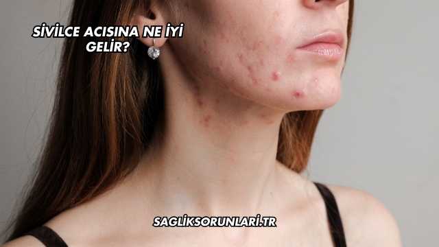 Sivilce Acısına Ne İyi Gelir?