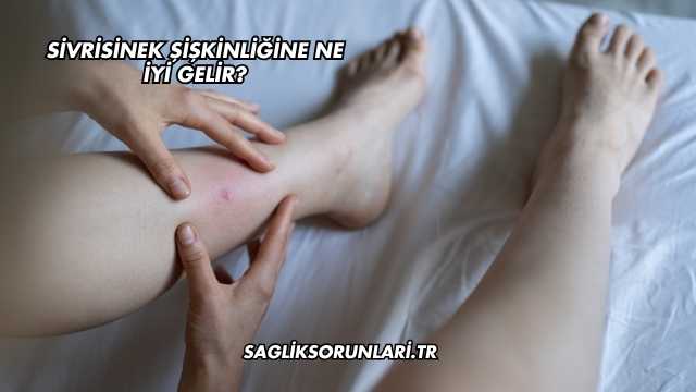 Sivrisinek Şişkinliğine Ne İyi Gelir?