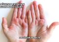 Soğuktan Çatlayan Ellere Ne İyi Gelir?