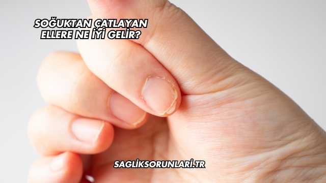 Soğuktan Çatlayan Ellere Ne İyi Gelir?