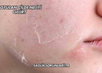 Soyulan Cilde Ne İyi Gelir?