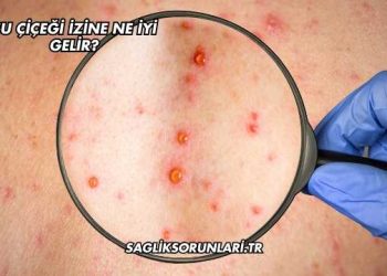 Su Çiçeği İzine Ne İyi Gelir?