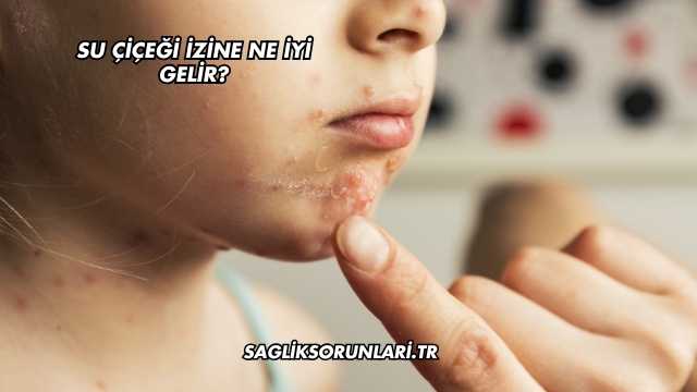 Su Çiçeği İzine Ne İyi Gelir?
