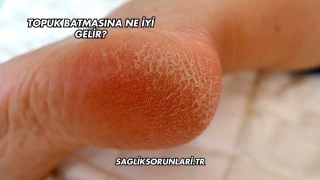 Topuk Batmasına Ne İyi Gelir?
