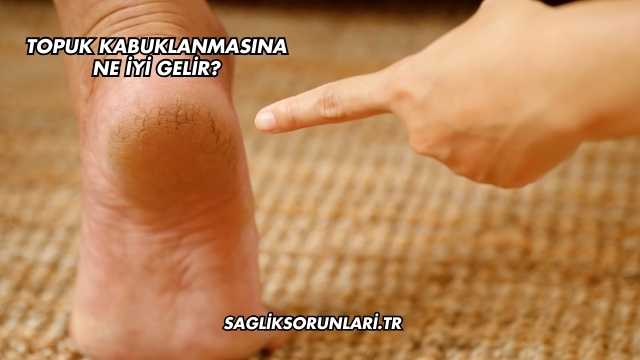 Topuk Kabuklanmasına Ne İyi Gelir?