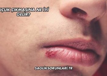 Uçuk Çıkmasına Ne İyi Gelir?