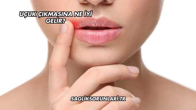 Uçuk Çıkmasına Ne İyi Gelir?