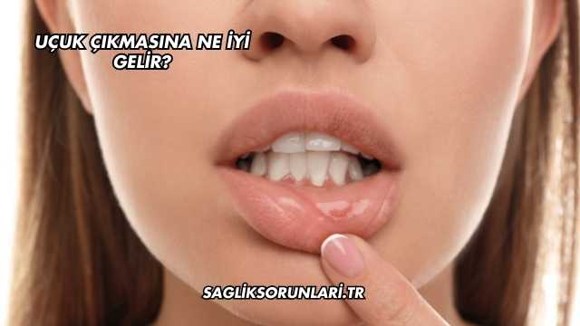 Uçuk Çıkmasına Ne İyi Gelir?
