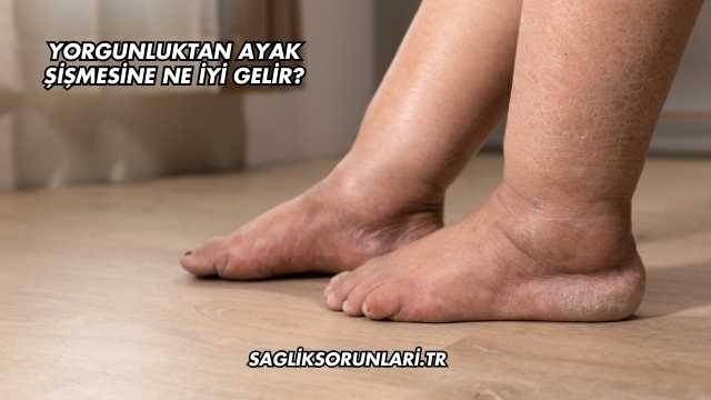 Yorgunluktan Ayak Şişmesine Ne İyi Gelir?