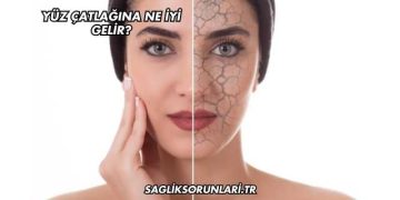 Yüz Çatlağına Ne İyi Gelir?