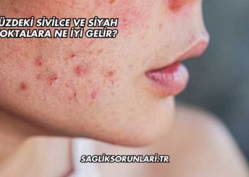 Yüzdeki Sivilce ve Siyah Noktalara Ne İyi Gelir?