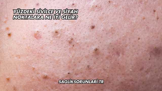 Yüzdeki Sivilce ve Siyah Noktalara Ne İyi Gelir?