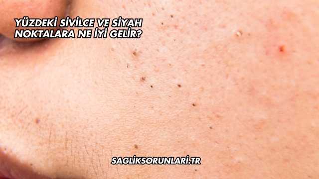 Yüzdeki Sivilce ve Siyah Noktalara Ne İyi Gelir?