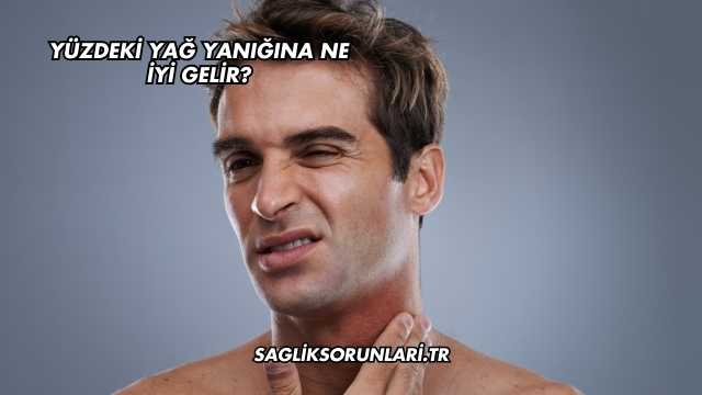 Yüzdeki Yağ Yanığına Ne İyi Gelir?