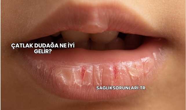 Çatlak Dudağa Ne İyi Gelir?