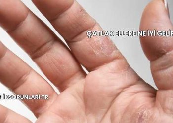 Çatlak Ellere Ne İyi Gelir?