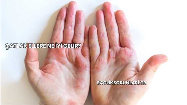 Çatlak Ellere Ne İyi Gelir?
