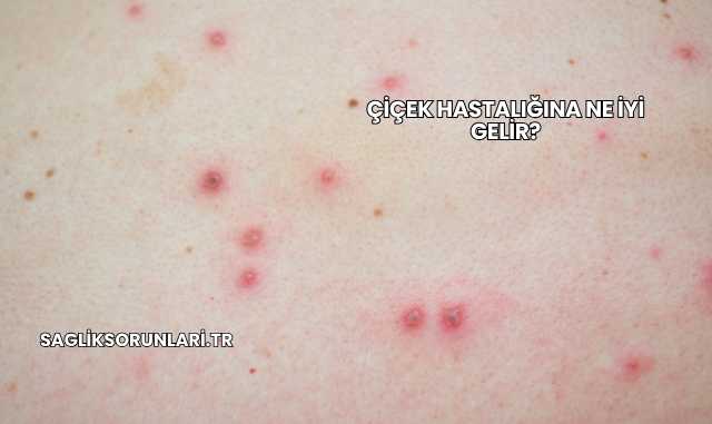 Çiçek Hastalığına Ne İyi Gelir?