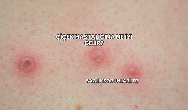 Çiçek Hastalığına Ne İyi Gelir?