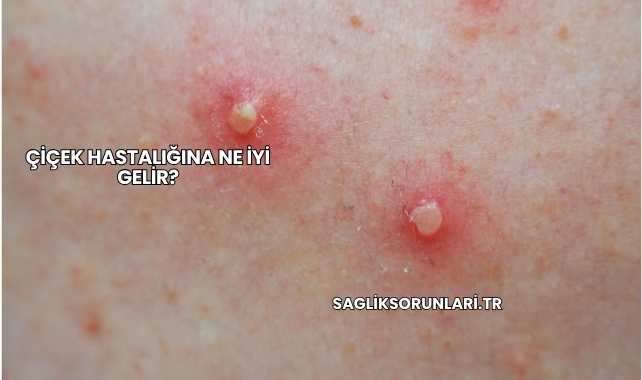 Çiçek Hastalığına Ne İyi Gelir?
