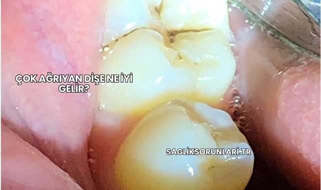 Çok Ağrıyan Dişe Ne İyi Gelir?