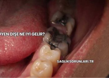 Çürüyen Dişe Ne İyi Gelir?
