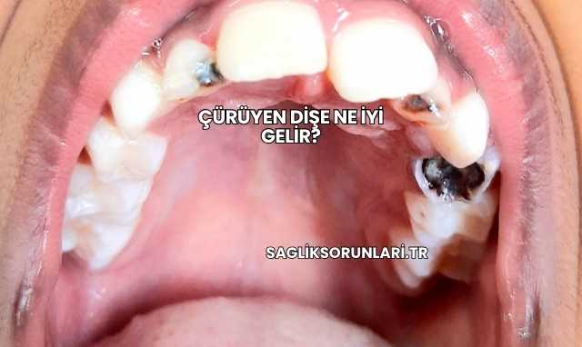 Çürüyen Dişe Ne İyi Gelir?