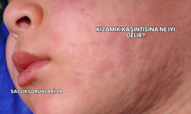 Kızamık Kaşıntısına Ne İyi Gelir?