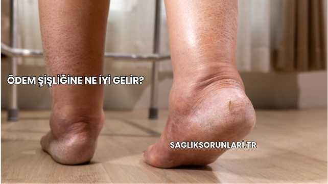 Ödem Şişliğine Ne İyi Gelir?