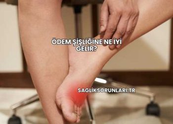 Ödem Şişliğine Ne İyi Gelir?