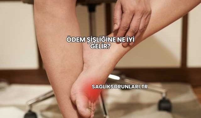 Ödem Şişliğine Ne İyi Gelir?