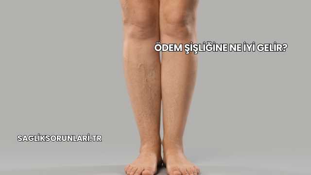 Ödem Şişliğine Ne İyi Gelir?