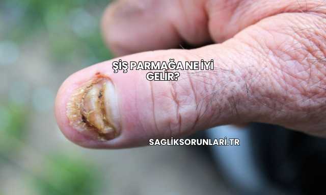Şiş Parmağa Ne İyi Gelir?