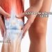 Üst Bacak Ağrısına Ne İyi Gelir?