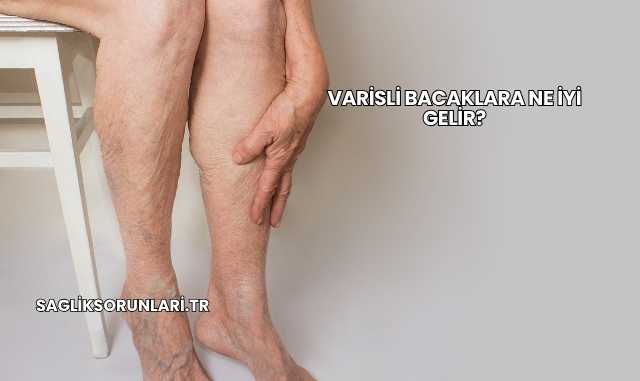 Varisli Bacaklara Ne İyi Gelir?