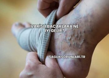 Varisli Bacaklara Ne İyi Gelir?