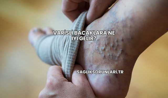 Varisli Bacaklara Ne İyi Gelir?