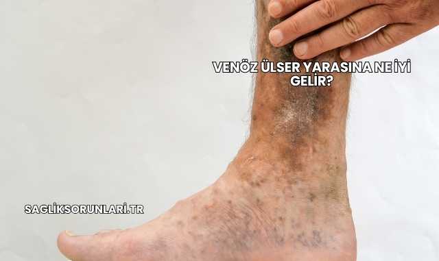 Venöz Ülser Yarasına Ne İyi Gelir?