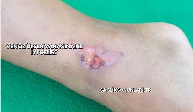 Venöz Ülser Yarasına Ne İyi Gelir?