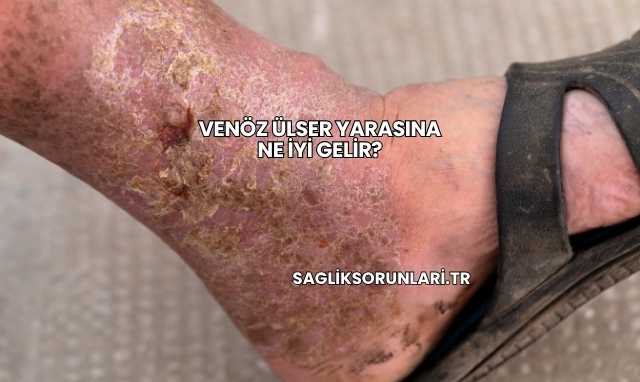 Venöz Ülser Yarasına Ne İyi Gelir?