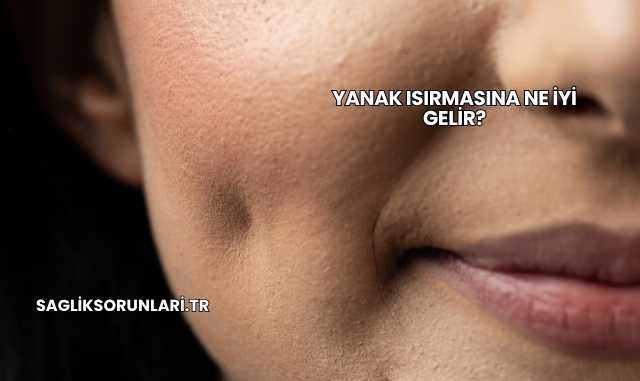 Yanak Isırmasına Ne İyi Gelir?